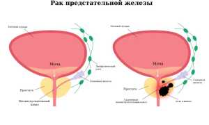 Рак предстательной железы