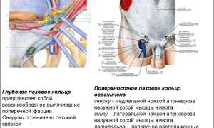 Почему появляется паховая грыжа у женщин и как ее лечить?