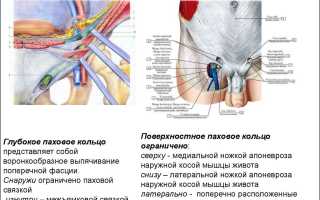 Почему появляется паховая грыжа у женщин и как ее лечить?