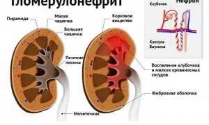 Гломерулонефрит постинфекционный