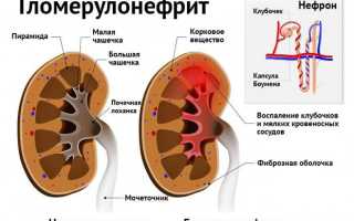 Гломерулонефрит постинфекционный