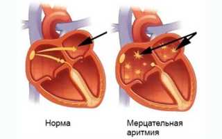 Почему возникает мерцательная аритмия сердца и как ее лечить?