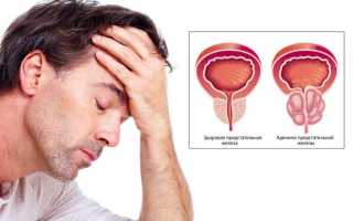 Лечение аденомы простаты — консервативная терапия или операция?
