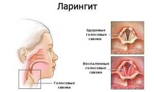 Ребенок страдает от ларингита? Узнайте, как ему помочь