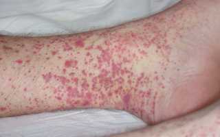 Васкулит — причины заболевания и методы лечения