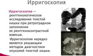 Как проводится ирригоскопия кишечника? Подготовка к процедуре
