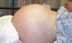 Сколько живут с циррозом печени? О каких факторах важно знать