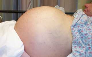 Сколько живут с циррозом печени? О каких факторах важно знать