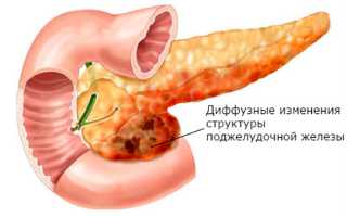 Диффузные изменения паренхимы поджелудочной железы — симптомы и лечение