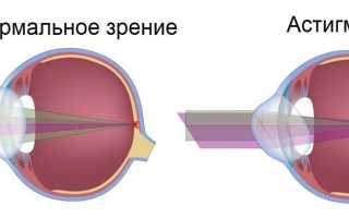 Астигматизм при дальнозоркости