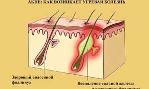 От чего возникают прыщи на спине и как с ними бороться?