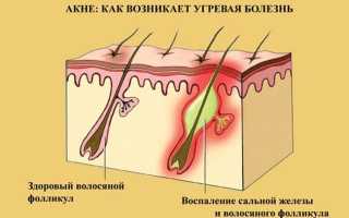От чего возникают прыщи на спине и как с ними бороться?