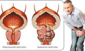 Что означает анализ ПСА? Нормы ПСА, их расшифровка и значение