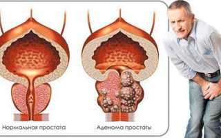 Что означает анализ ПСА? Нормы ПСА, их расшифровка и значение