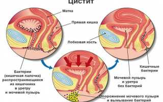 Цистит: причины, осложнения, терапия