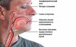 Анафилактический шок — как предотвратить смертельную опасность? Симптомы, причины, неотложная помощь