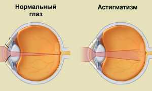 Что такое астигматизм?