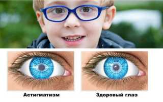 Причины и лечение врожденного астигматизма