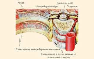 Межреберная невралгия — причины, признаки, лечение
