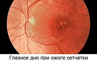 Симптомы и лечение ожога сетчатки глаза