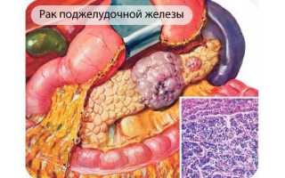 Как распознать рак поджелудочной железы? Симптомы, диагностика, лечение