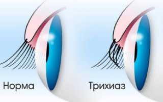 Симптомы и лечение трихиаза века