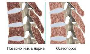 Как проявляется остеопороз позвоночника и чем его лечить?