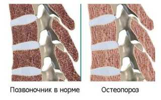 Как проявляется остеопороз позвоночника и чем его лечить?