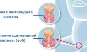 Узловой зоб щитовидной железы — причины, симптомы, лечение