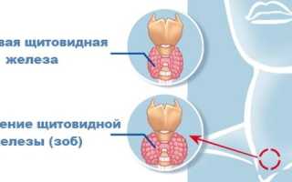 Узловой зоб щитовидной железы — причины, симптомы, лечение