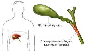 Застой желчи — что его вызывает и как от него избавиться?