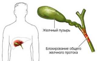 Застой желчи — что его вызывает и как от него избавиться?