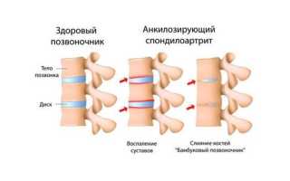 Болезнь Бехтерева у женщин — как выявить и вылечить патологию?