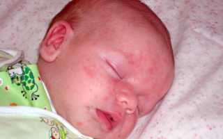 Золотистый стафилококк у грудничка – причины, симптомы и лечение
