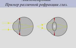Большая разница в зрении