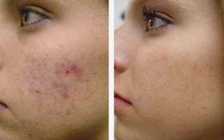 Лечение акне