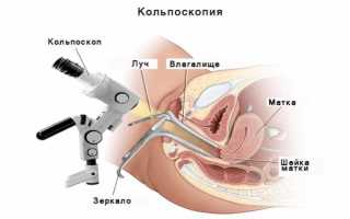 Кольпоскопия – что это такое и как часто ее надо делать?