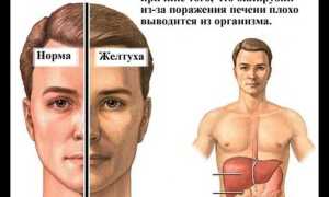 Желтуха у взрослых: симптомы, причины, лечение