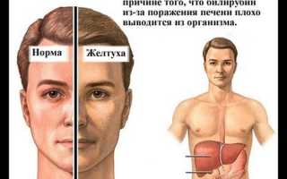 Желтуха у взрослых: симптомы, причины, лечение