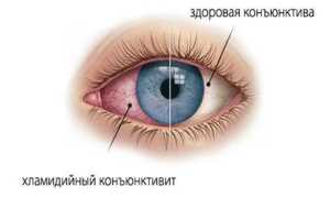 Виды и лечение хламидийного конъюнктивита