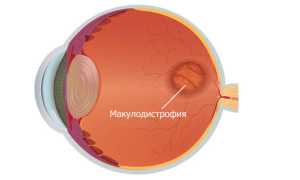 Симптомы и лечение макулодистрофии сетчатки глаза