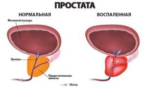 Почему возникает простатит у мужчин и чем его лечить? Профилактика патологии