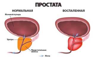 Почему возникает простатит у мужчин и чем его лечить? Профилактика патологии
