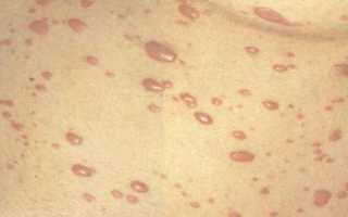 Сифилис — первые признаки, лечение, последствия