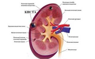 Киста почки — симптомы развития и методы лечения