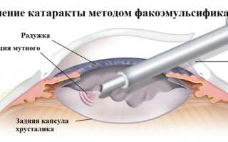 Операция ФЭК на глазах