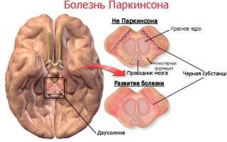 Болезнь Паркинсона — симптомы, лечение, образ жизни при заболевании