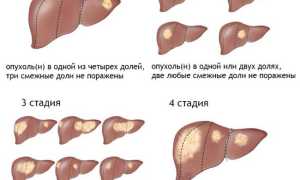 Рак печени – можно ли вылечить заболевание? Развитие патологии и методы его лечения