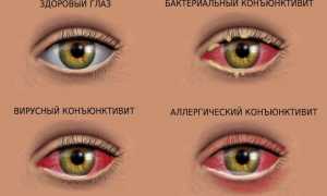 Что такое конъюнктивит глаз: основные причины, симптомы и подходы к лечению