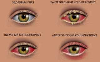 Что такое конъюнктивит глаз: основные причины, симптомы и подходы к лечению